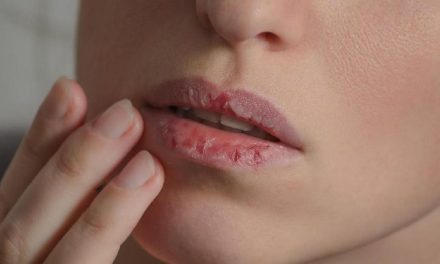 Dokter Gigi Peringatkan Bahaya Kondisi Dari Mulut Yang Kering