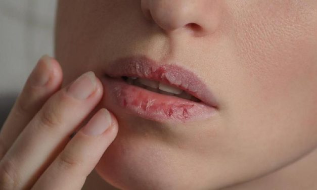 Dokter Gigi Peringatkan Bahaya Kondisi Dari Mulut Yang Kering