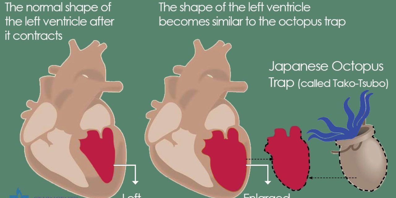 Sindrom Patah Hati, Yaitu Sindrom Kardiomiopati Takotsubo
