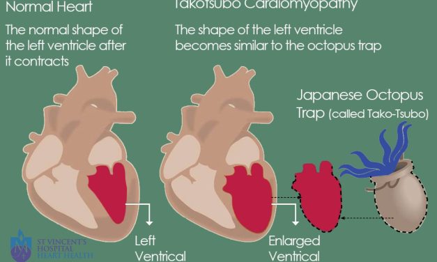 Sindrom Patah Hati, Yaitu Sindrom Kardiomiopati Takotsubo