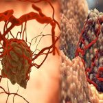 Tumor Jinak Yang Tidak Termasuk Penyakit Kanker