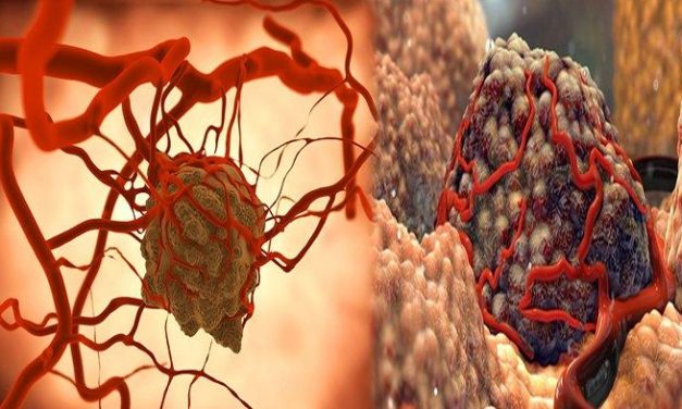 Tumor Jinak Yang Tidak Termasuk Penyakit Kanker